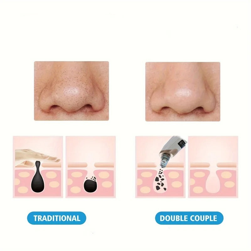 A rechargeable 5-in-1 vacuum suction blackhead remover machine